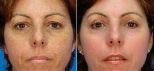 фракциялық тегістеу